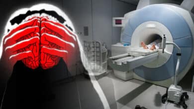 New MRI technique may relieve depression symptoms up to 6 months