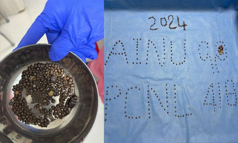 AINU removed 418 kidney stones from a 60-yr-old patient