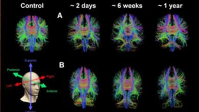 New MRI technique may better predict fatigue, headaches in concussion patients