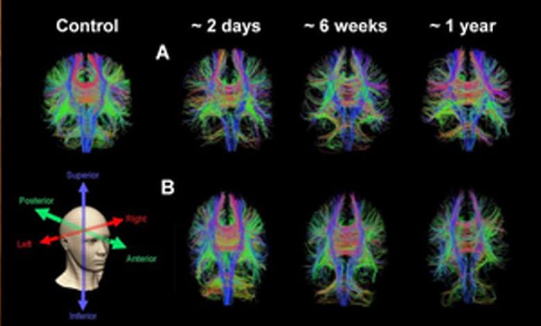 New MRI technique may better predict fatigue, headaches in concussion patients