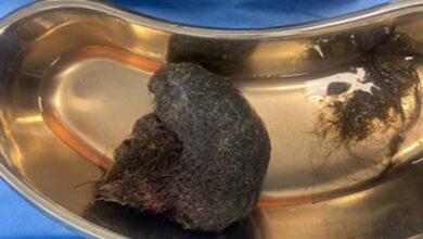 Bengaluru doctors remove cricket ball-sized hairball from 8-year-old’s stomach