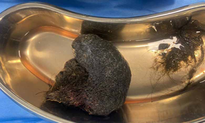 Bengaluru doctors remove cricket ball-sized hairball from 8-year-old’s stomach