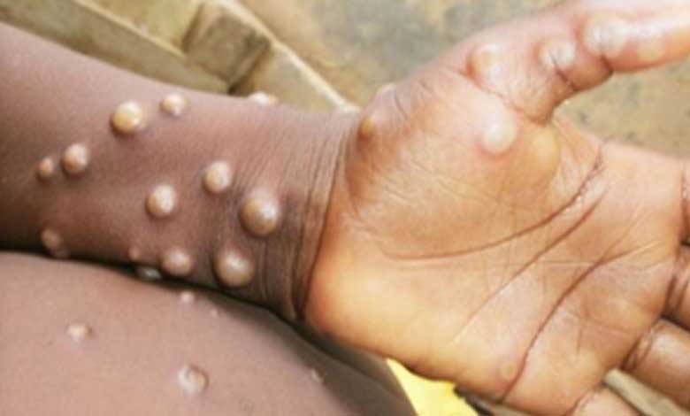 No reported case of Mpox in India, PM continuously monitoring situation: Centre