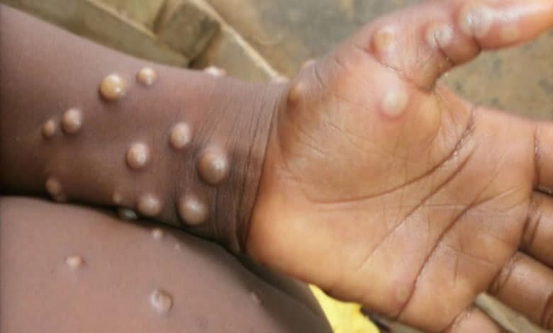 Mpox impacting a broader demographic, warns Lancet report