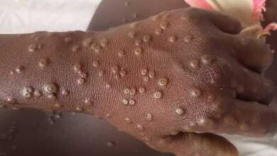 11 Mpox cases reported in 2024 from S.Korea, no new virus strain