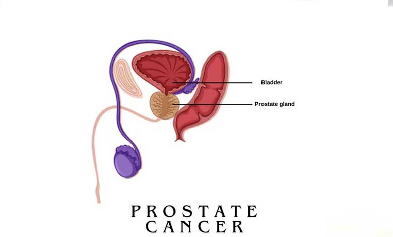 Prostate cancer cases rising among men aged below 50 in India: Experts