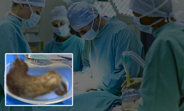 2kg human hair found in woman's stomach