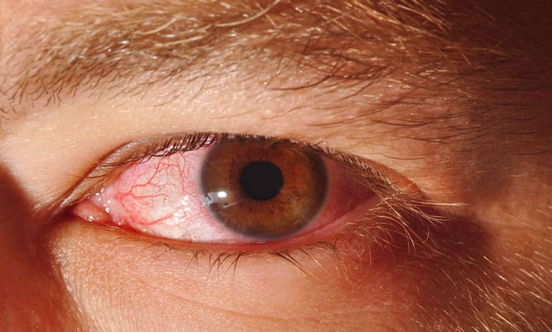 How to avoid eye infections – and what to do if you get one